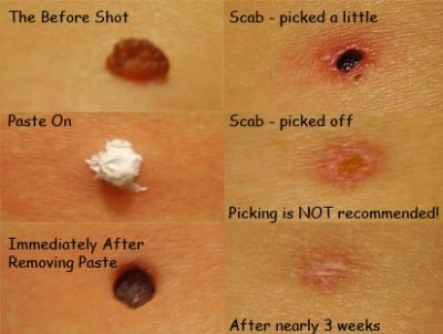 scar moles cider classifieds777 homeopathic numbing numb