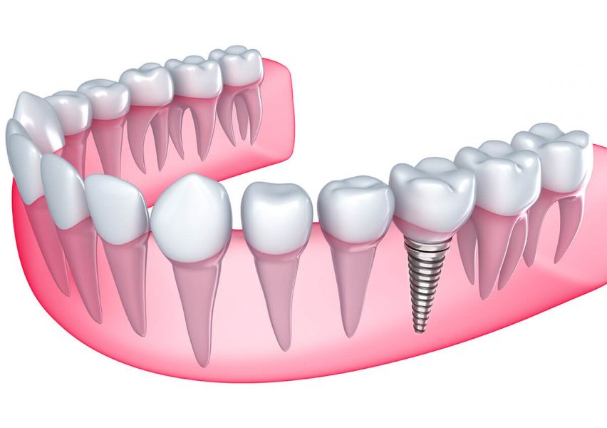 Importance Of Dental Implants for Missing Teeth New York