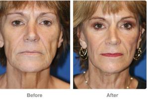 Facial fat grafting