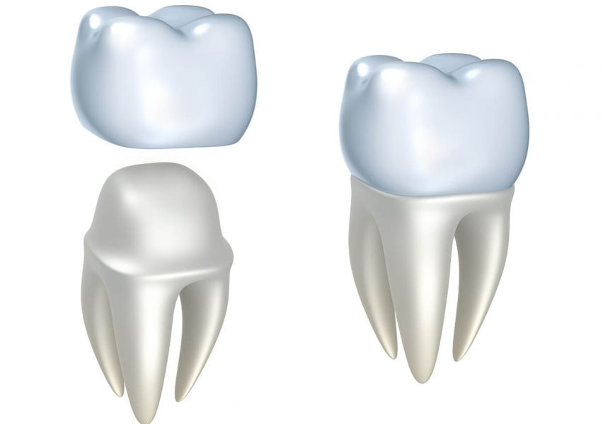 Dental Crowns Service New York