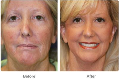 Foreheadlift by Dr. Robert Troell