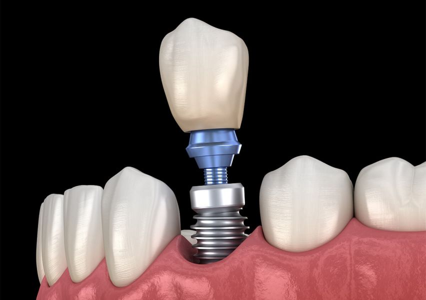 Dental Implants New York NY