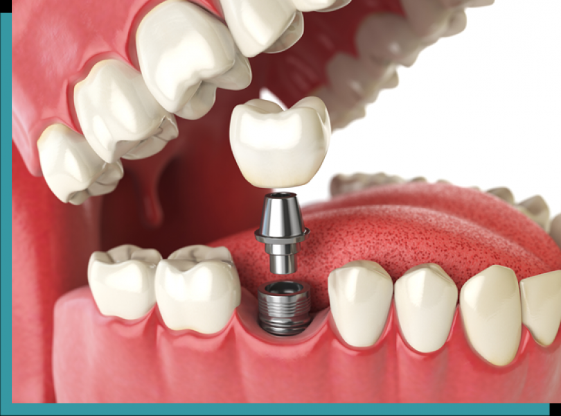 Dr. Mario Castellanos- Recommended Local Dental Implants Rancho Cucamonga - 91730