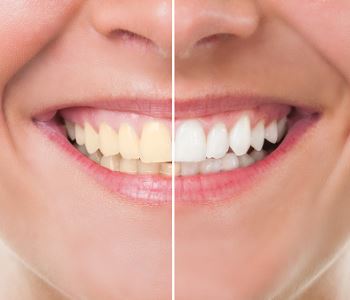 Dr. Sakunthala Boppana Affordable Teeth Whitening in Garland TX - 75044 
