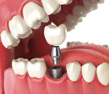 Find Dental Implants Garland TX - Dr. Sakunthala Boppana - Local Dentist 