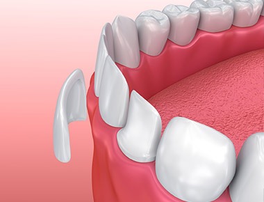 Visit Dr. Mike Milligan - Best Results Dental Veneers Bloomington IL 