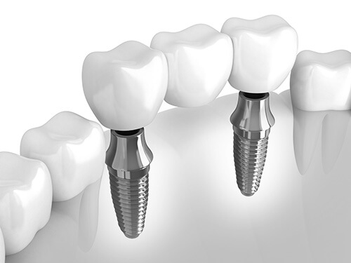 Certified Dental Implants Los Angeles - Dr. Mamta Dalwani 