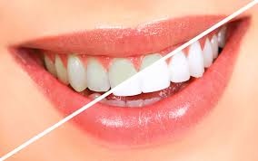 Teeth Whitening Atlanta GA Near To Me - Dr. Michaela McKenzie 